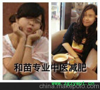 观音桥街道重庆男士减肥 重庆市专业的重庆中医针灸埋线减肥推荐